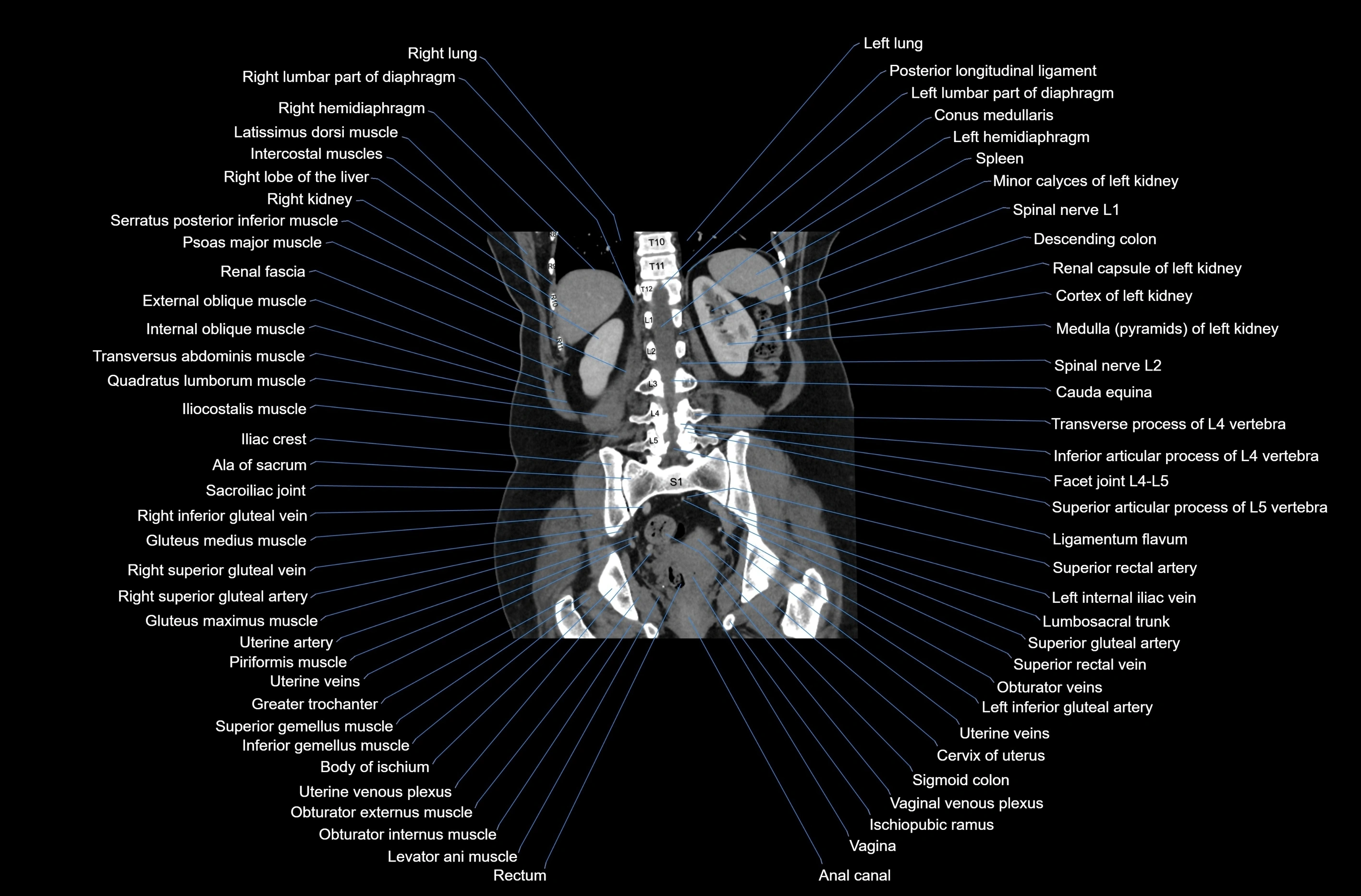 CT abdomen coronal cross sectional anatomy labelled radiology image-00062.webp